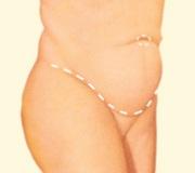tummy tuck incision side