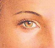 Eyelid surgery result