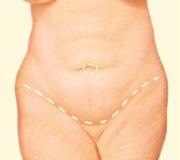 tummy tuck incision front