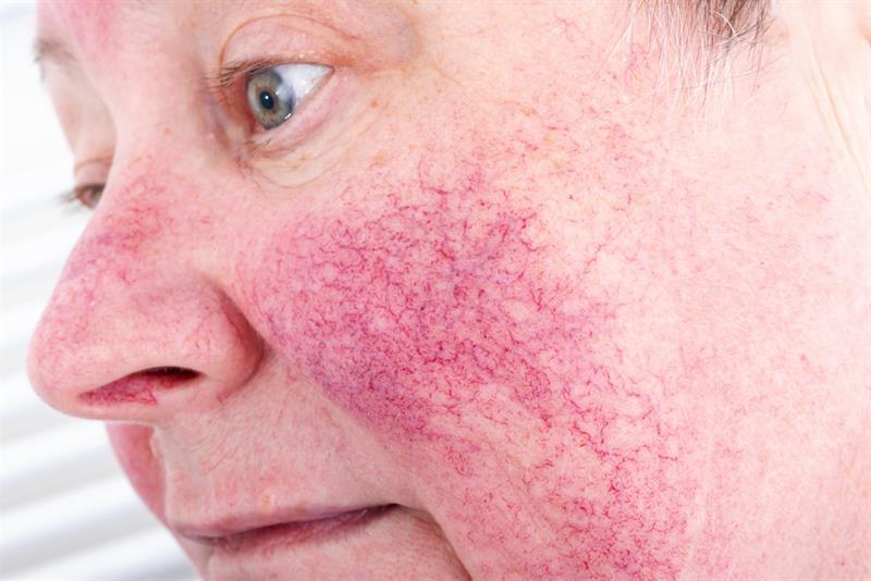 Rosacea: The Very Common Yet Unfamiliar Disease - Dermatology - Mediniz