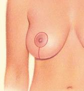 breast lift vertical result